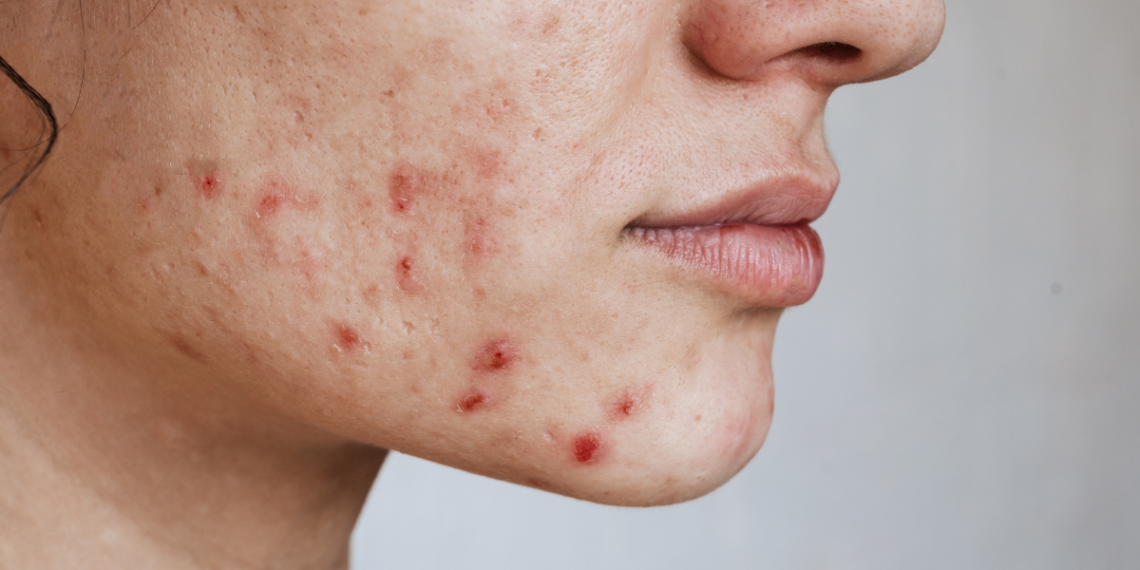 How to treat acne